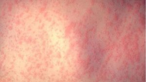 Measles man visited Werribee